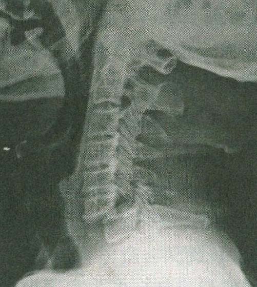 第二节 下颈椎骨折脱位